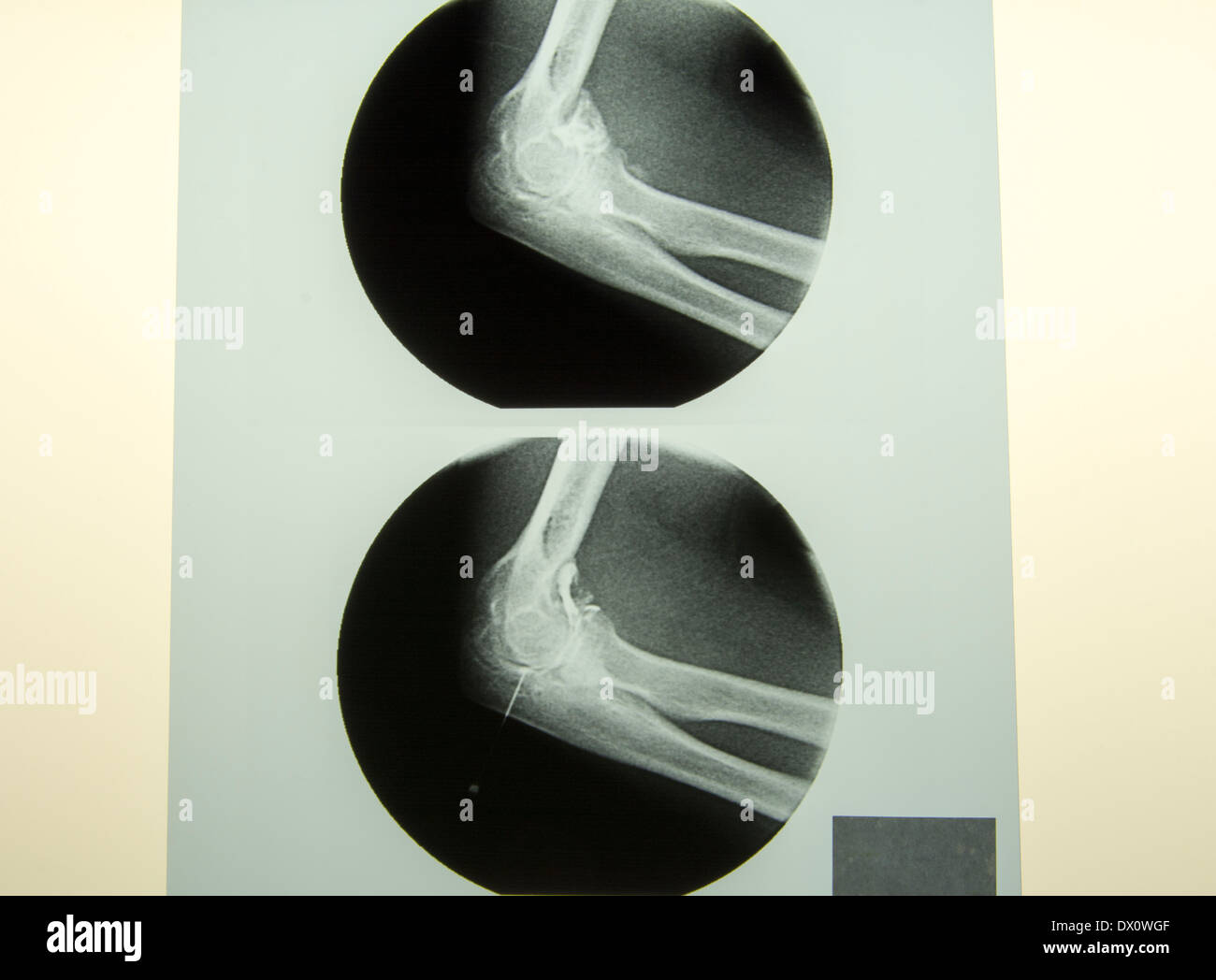 Needle XRAY Stock Photo Alamy