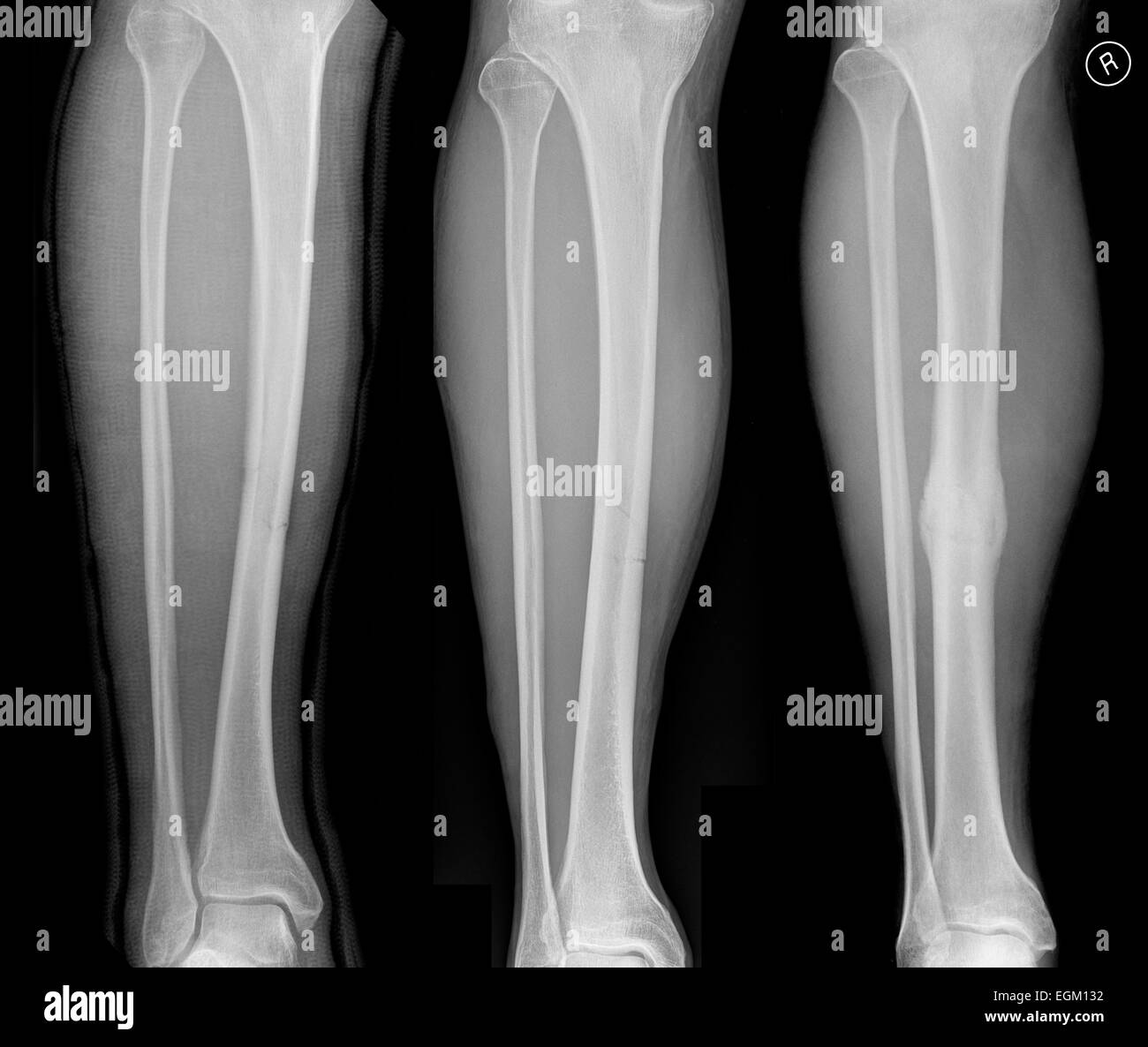 Bone Fracture Healing High Resolution Stock Photography and Images Alamy
