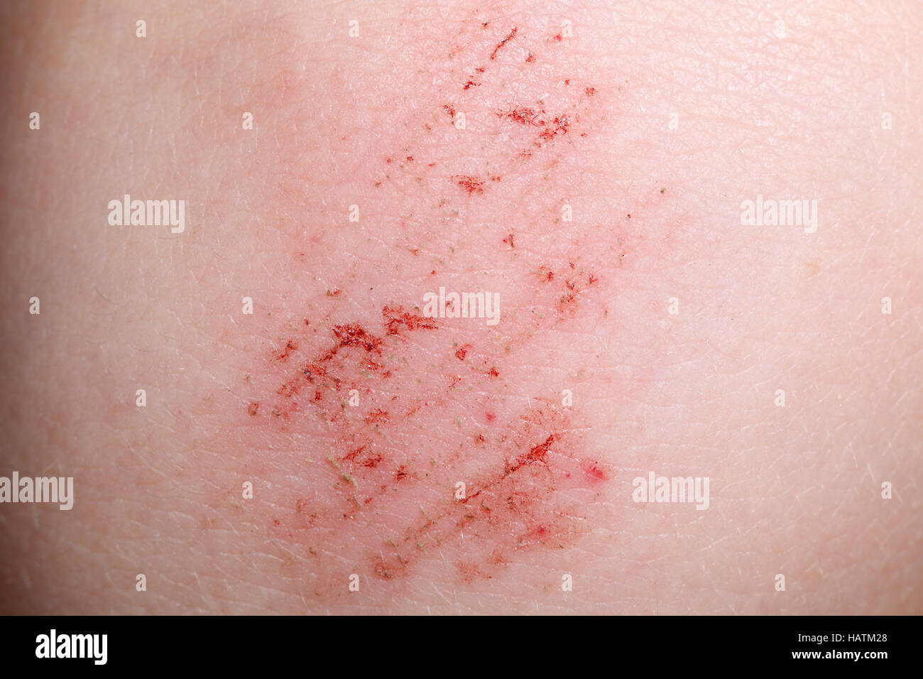Abrasion Knee Stock Photos & Abrasion Knee Stock Images Alamy