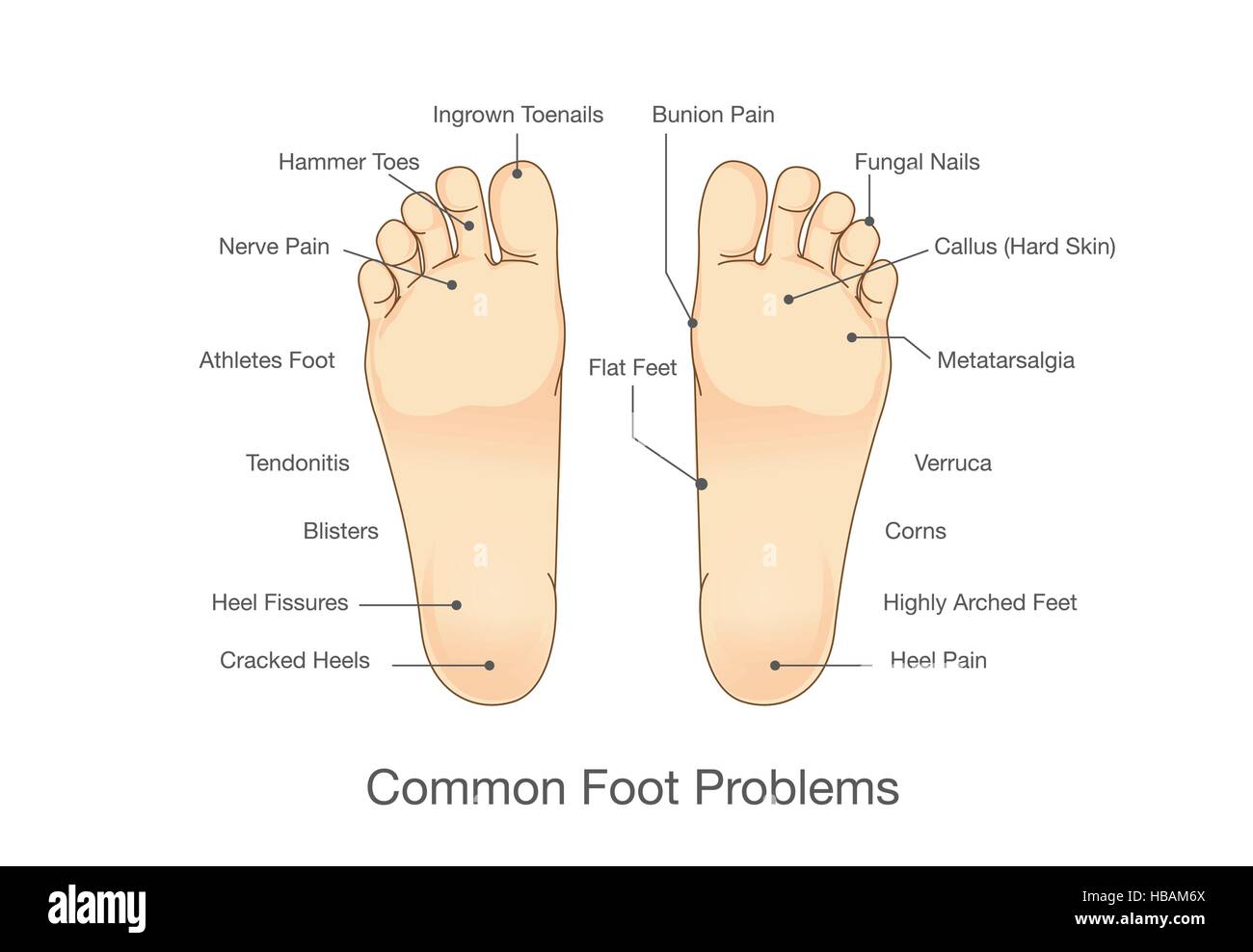 Common foot problems Stock Vector Image & Art Alamy