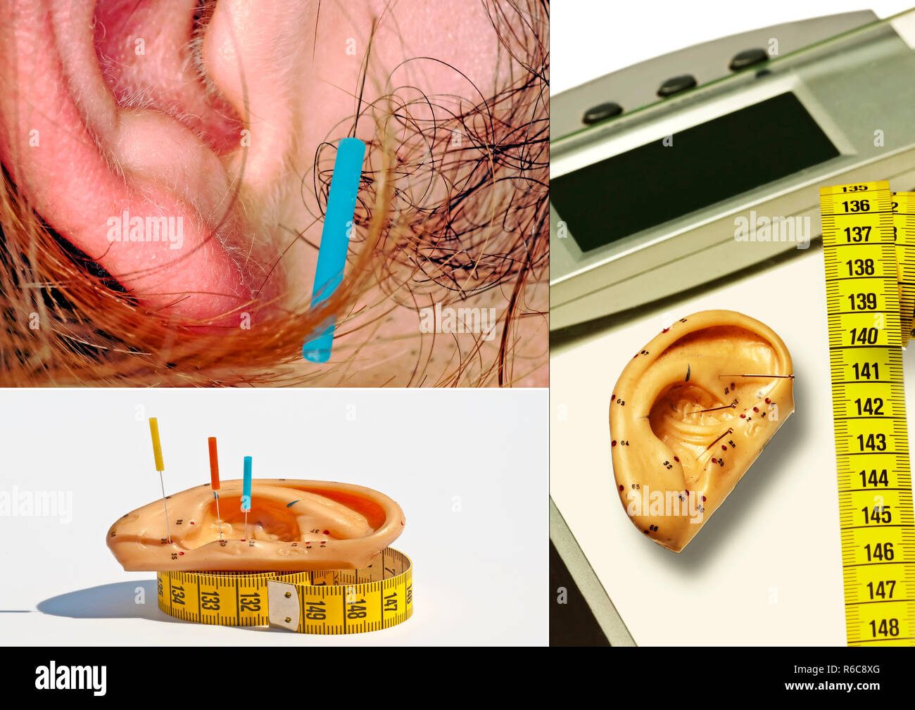 Ear Acupuncture For Weight Loss Stock Photo Alamy