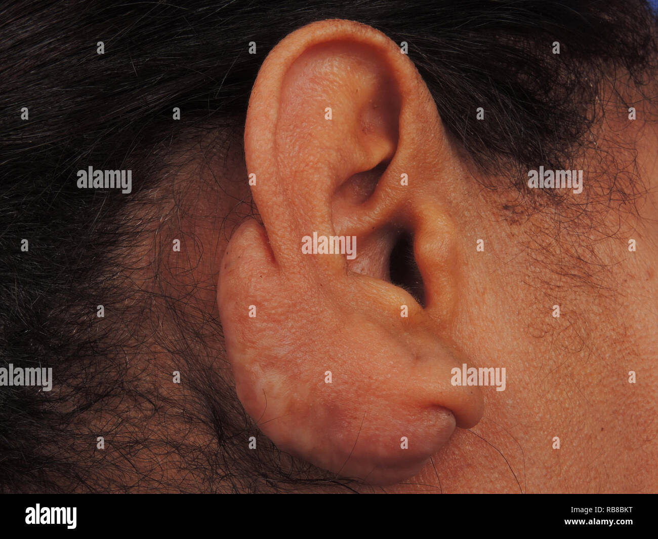 Keloids ear hires stock photography and images Alamy