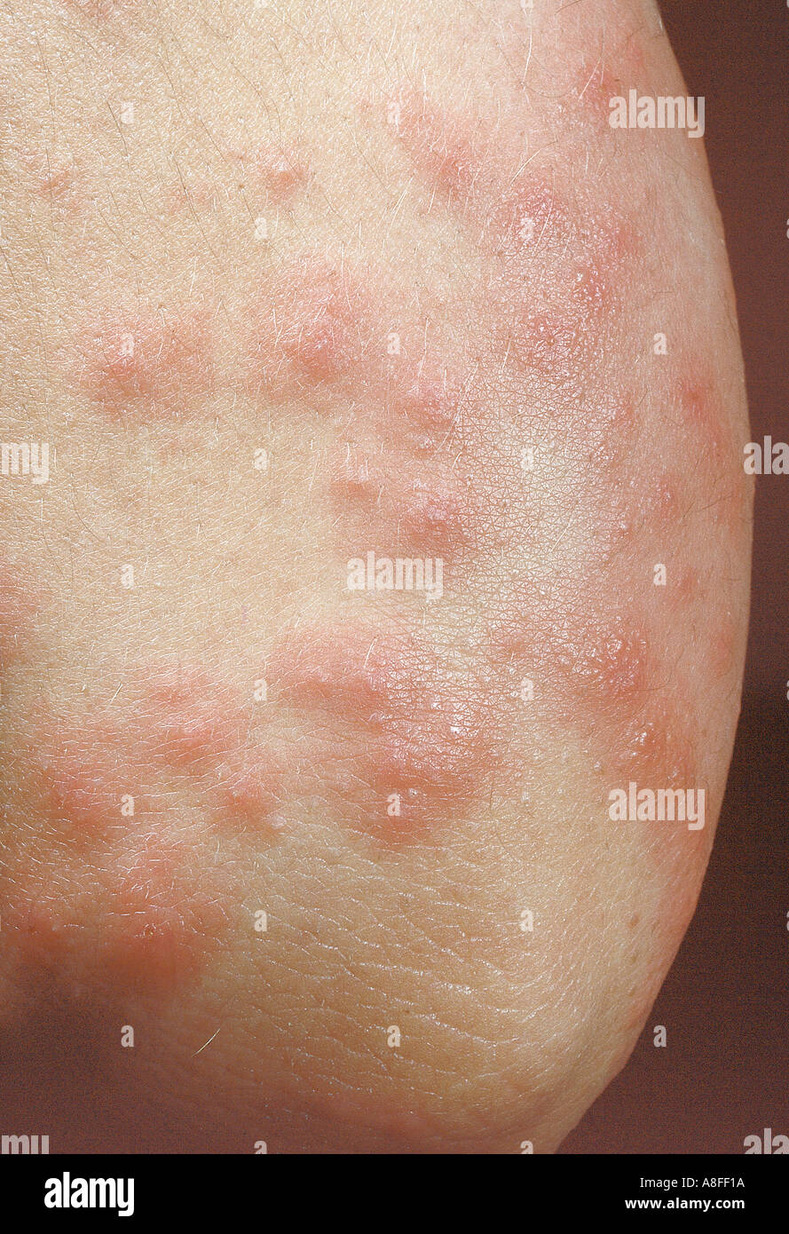 Erythema multiforme Stockfoto, Bild 589594 Alamy