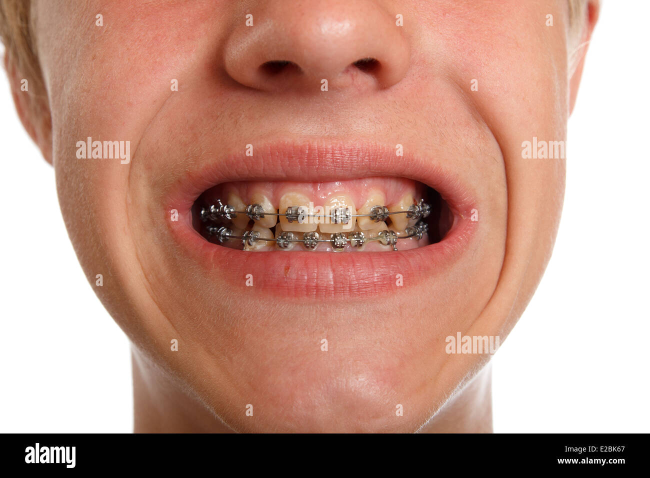 brackets de los dientes Fotografía de stock Alamy