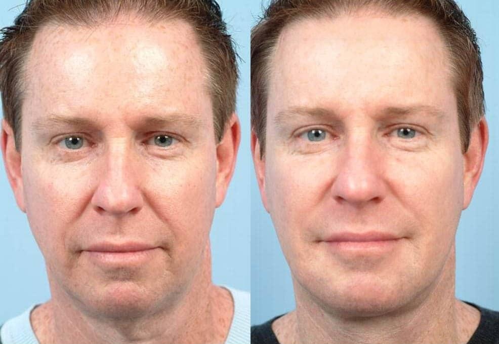 Double Chin Surgery For Men Toronto Plastic Surgeons
