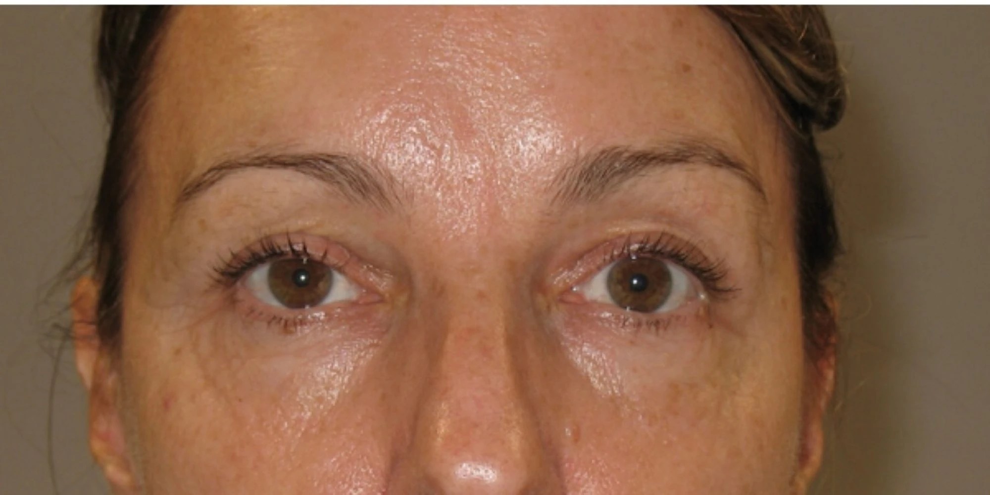 PDO NonSurgical Thread Lifts in Essex Woodford Medical