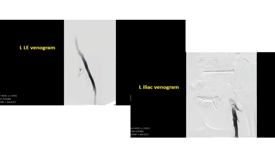 Coding Complex Vascular Cases AAPC Knowledge Center