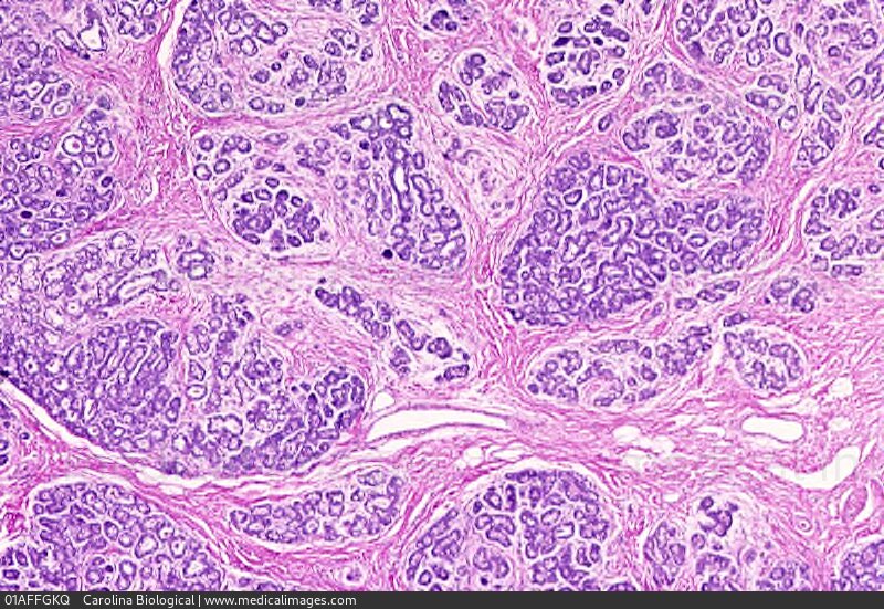STOCK IMAGE, photomicrograph of gravid macromastia or breast