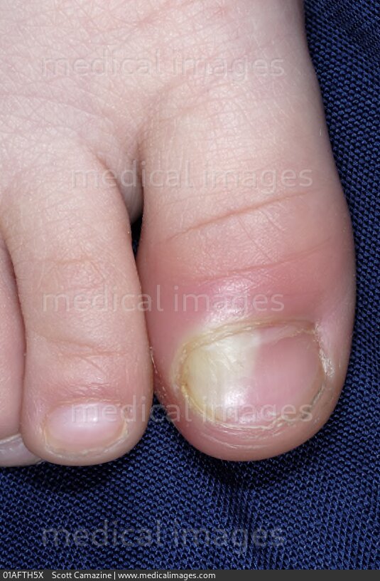 STOCK IMAGE, closeup of a paronychia infection around a toenail of a