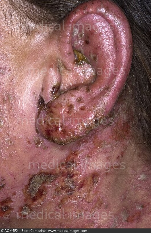 STOCK IMAGE, herpes zoster shingles rash with blisters on