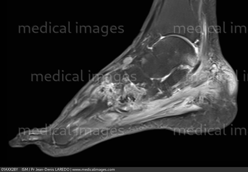 STOCK IMAGE, mri of gout of the foot with tophaceous deposits tophi in