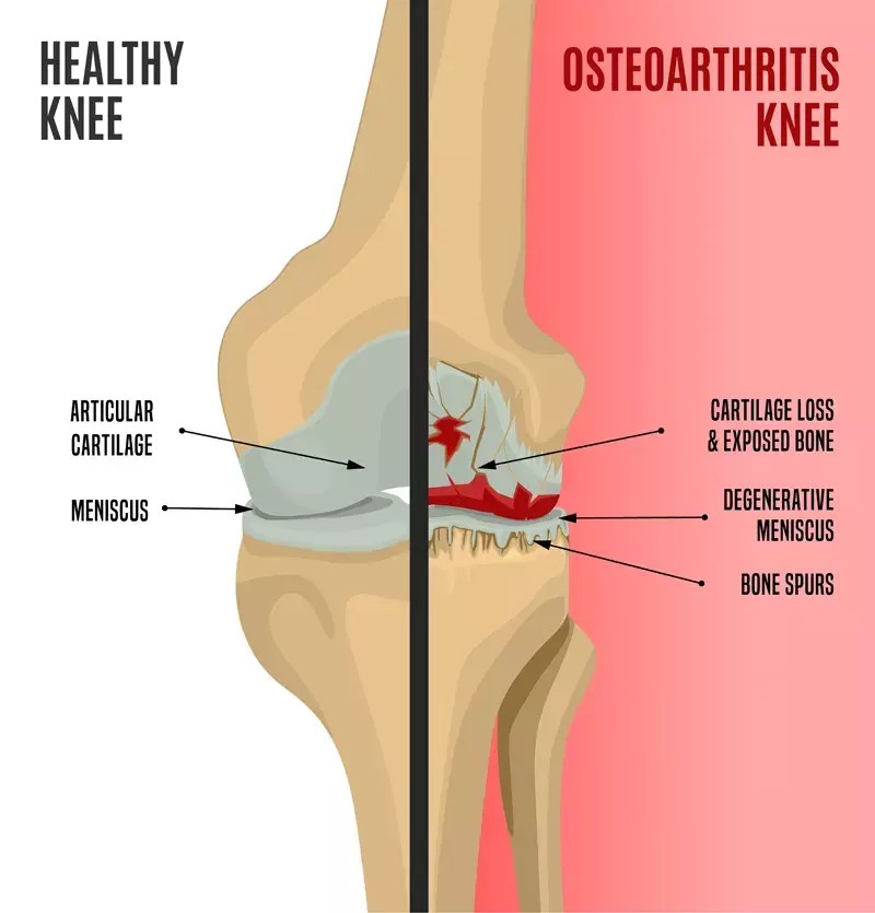 Osteoarthritic Knee Pain Center for Advanced Cardiac and Vascular