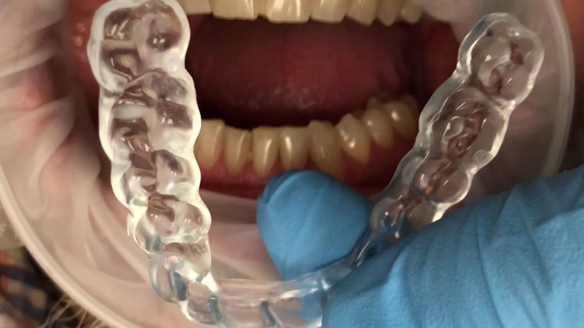 Two Buccal Bites for Occlusal Guard Fabrication
