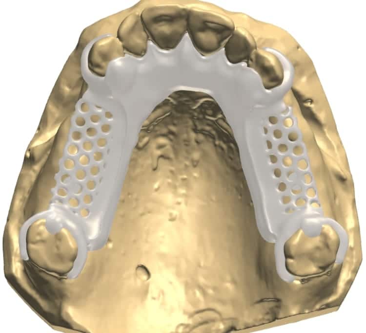 Flexible / Acetal Partial CAD Design CAE Dental