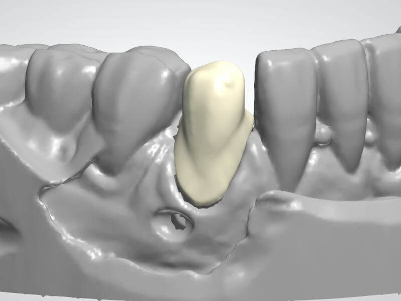 Coping Design Fee CAE Dental