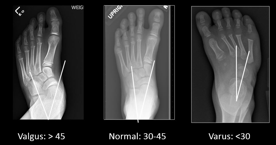 Pediatric foot alignment Dr Sachin Kumbhar’s talk Cafe Roentgen