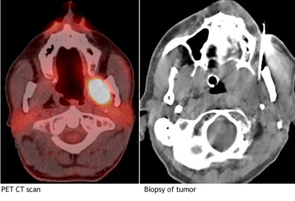 CT Guided Head & Neck Procedures California Center for