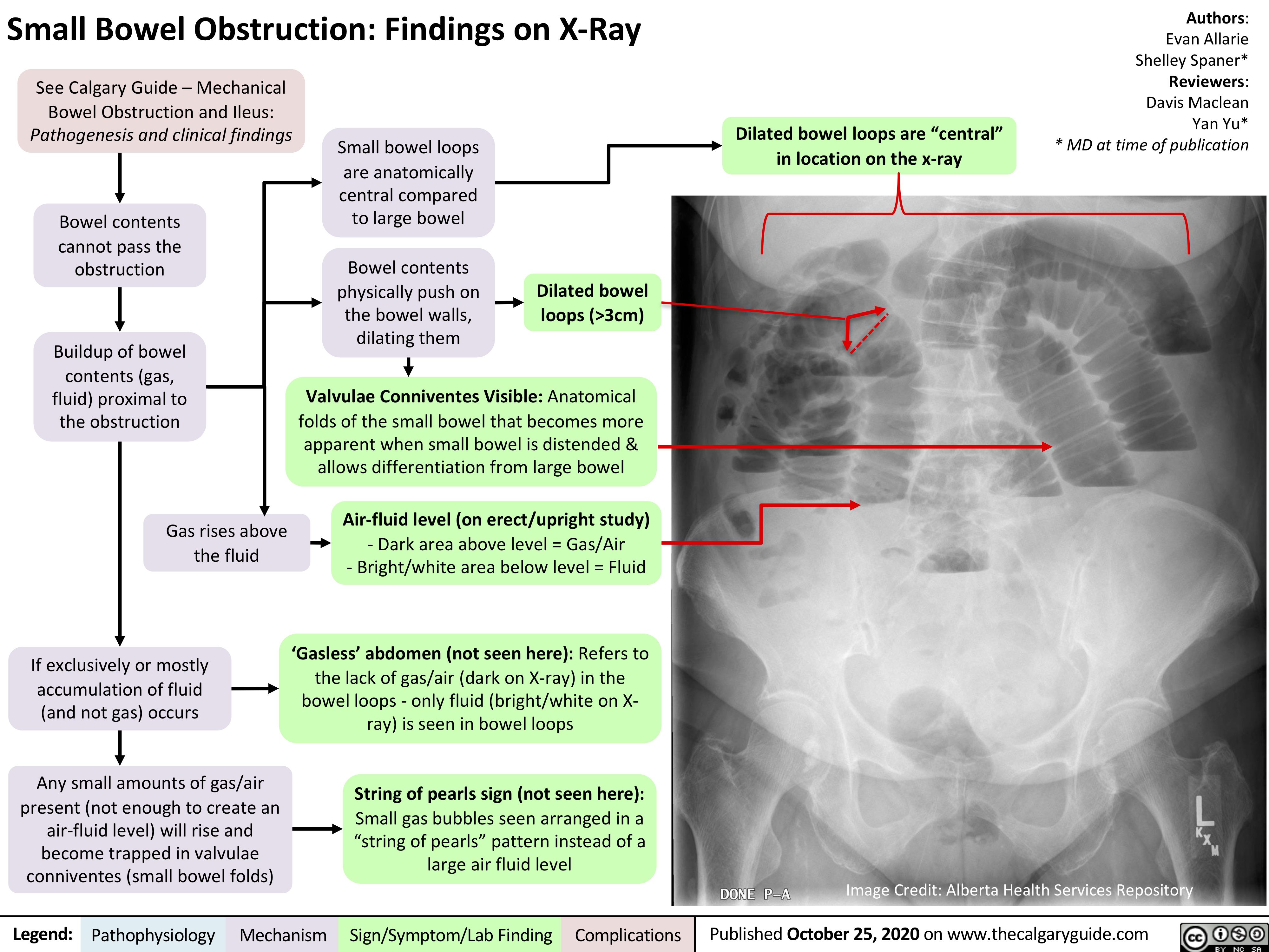 Small Bowel Obstruction Findings on XRay Calgary Guide