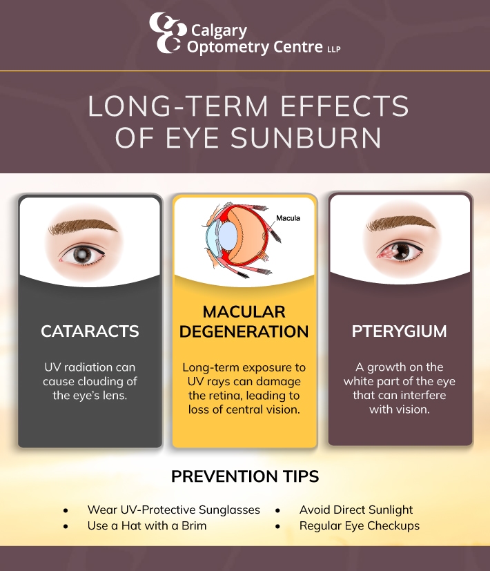 Can You Sunburn Your Eyes?