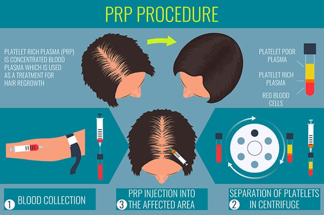 PRP plus Minoxidil beats PRP plus Finasteride More PRP