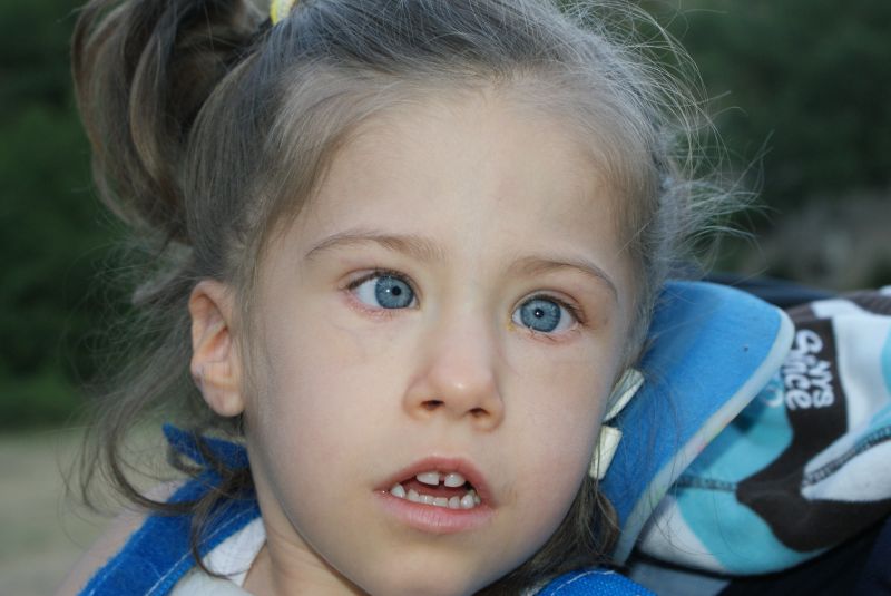 PraderWilli syndrome Wikipedia