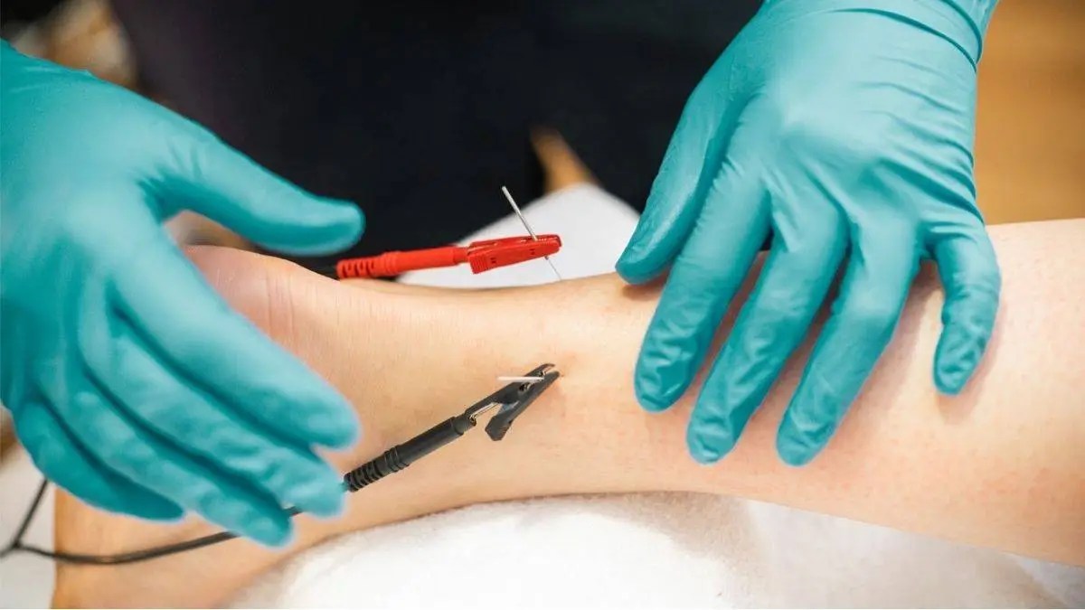 Trigger Point Acupuncture Pain Relief Releases Muscle Knots Morris