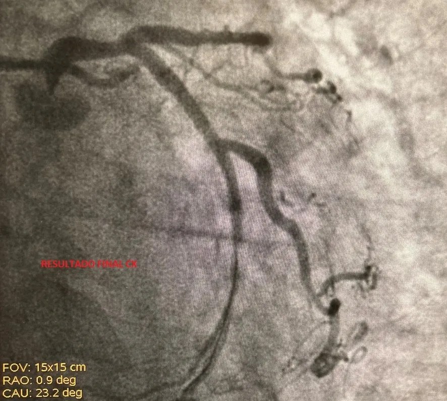 Experiencia inicial con el nuevo stent ONYX Frontier Campus de