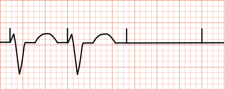 Pacemaker Essentials How to Interpret a Pacemaker ECG CanadiEM