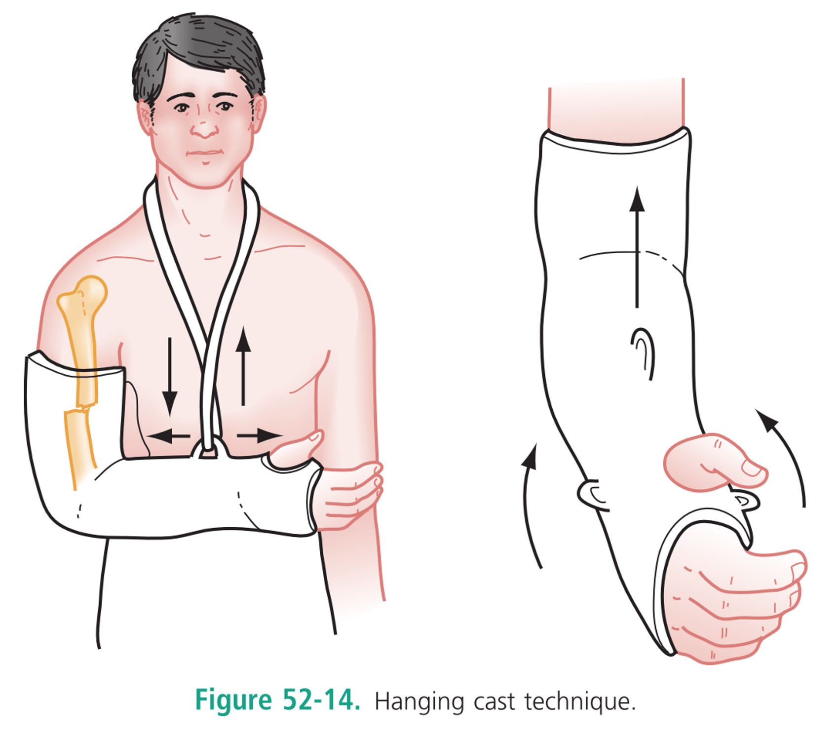 CRACKCast E052 Orthopedics Humerus and Elbow CanadiEM