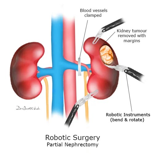 kidney Cancer Surgeon in Ahmedabad Robotic Kidney Cancer Surgery