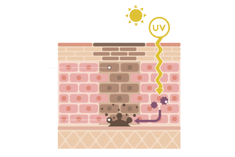 Patient Hyperpigmentation Treatment Candela Medical