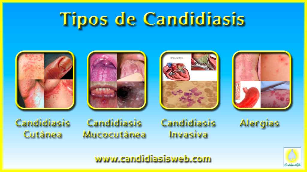 Tipos Clínicos de Candidiasis
