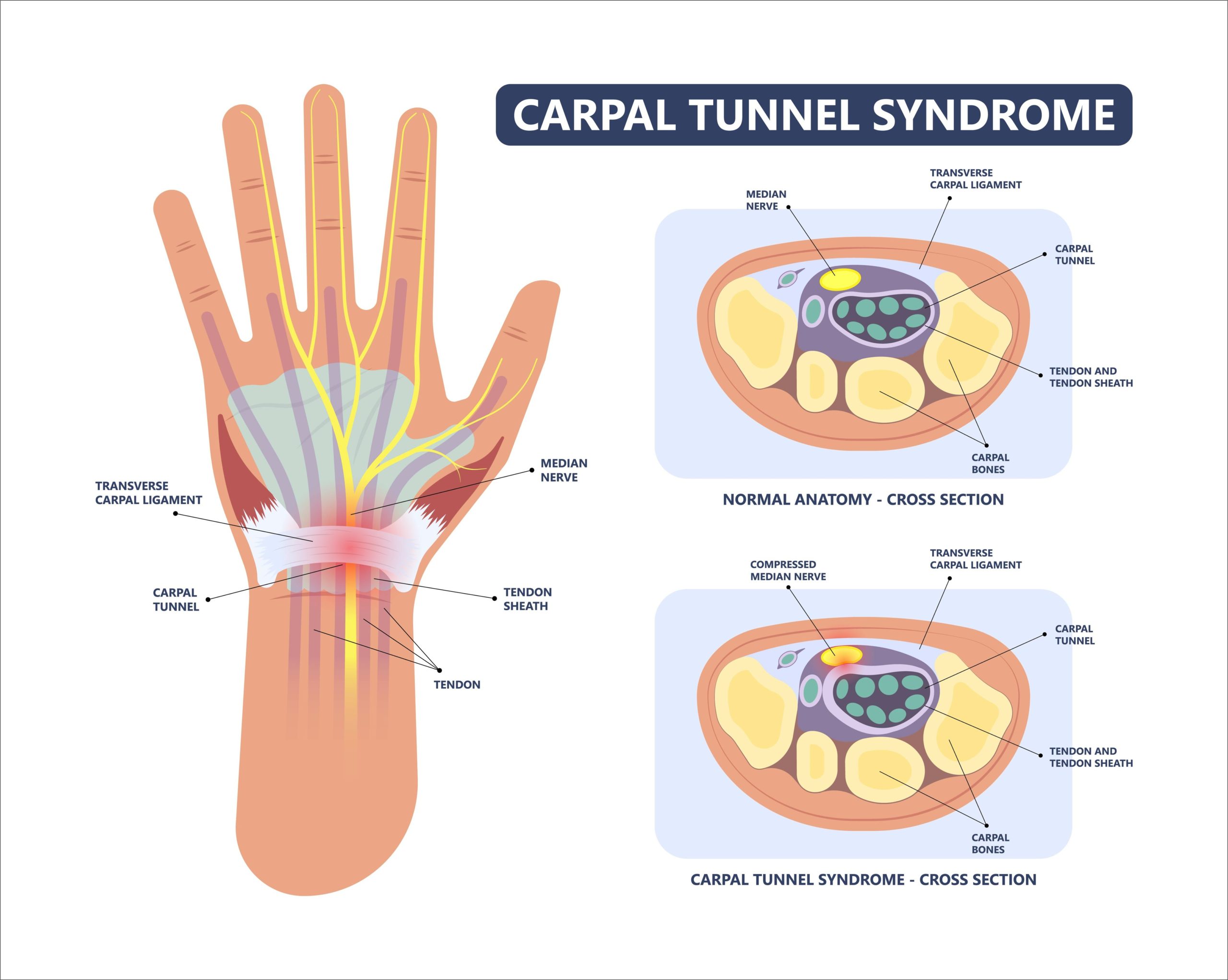 Median Nerve Carpal Tunnel