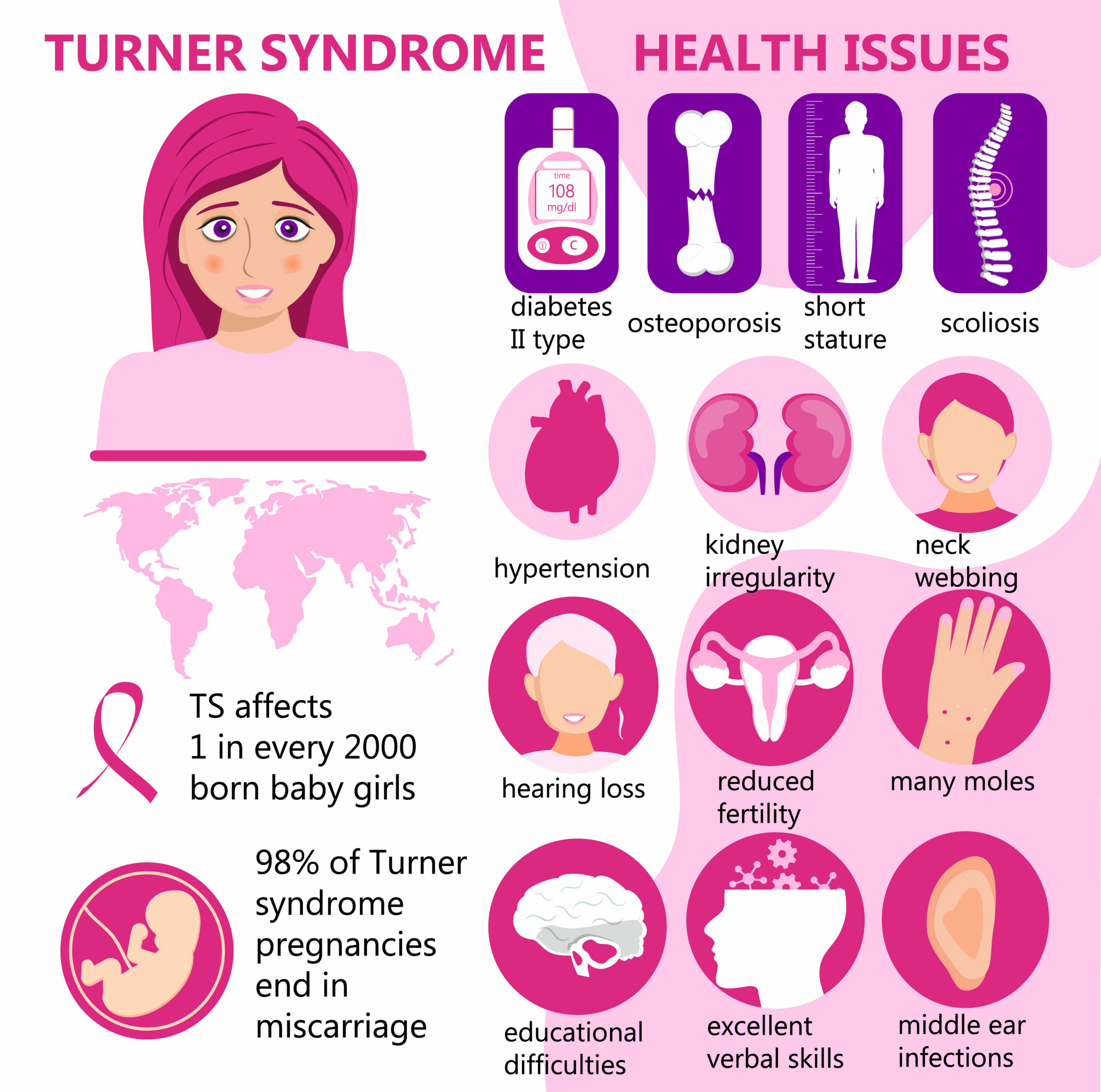 Turners Syndrome Baby