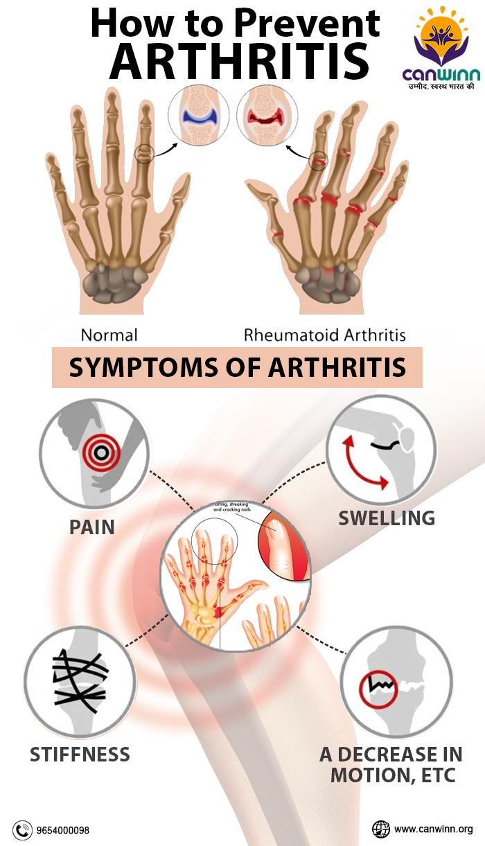 How to Prevent Arthritis 10 Easy Ways Follow Daily Routine Tips