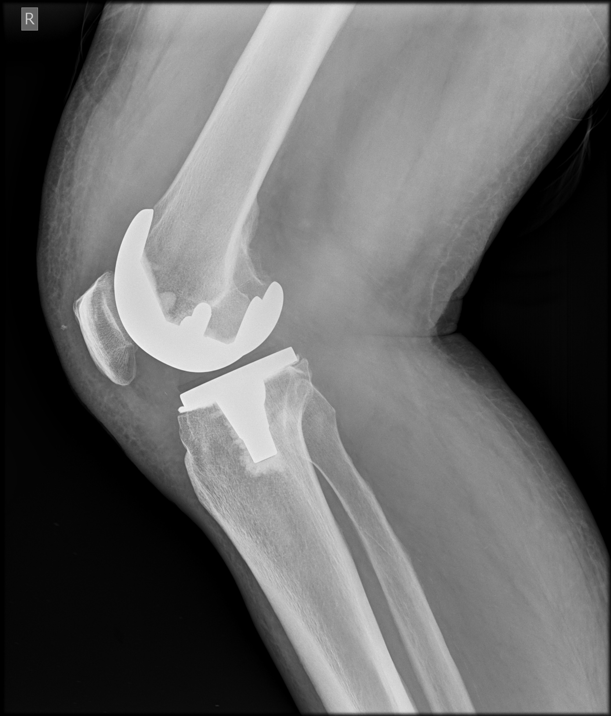 What is the Difference Between Arthroplasty & Arthroscopy?