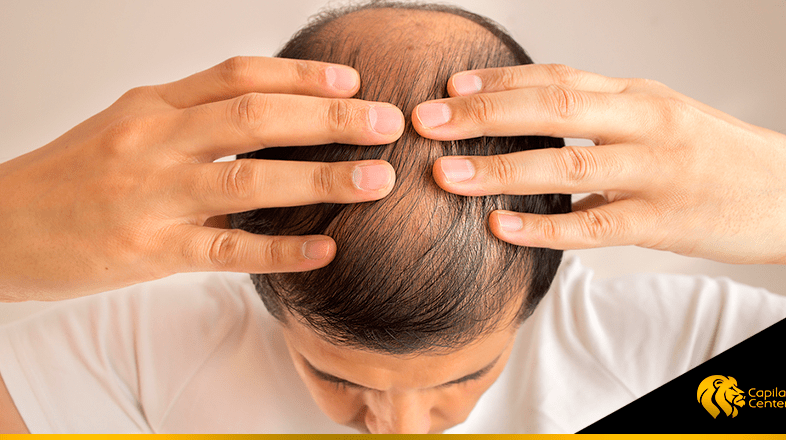 alopecia masculina archivos Capilar Center