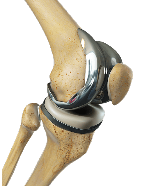 Considering joint replacement surgery? Capital City Surgery Center Raleigh Outpatient