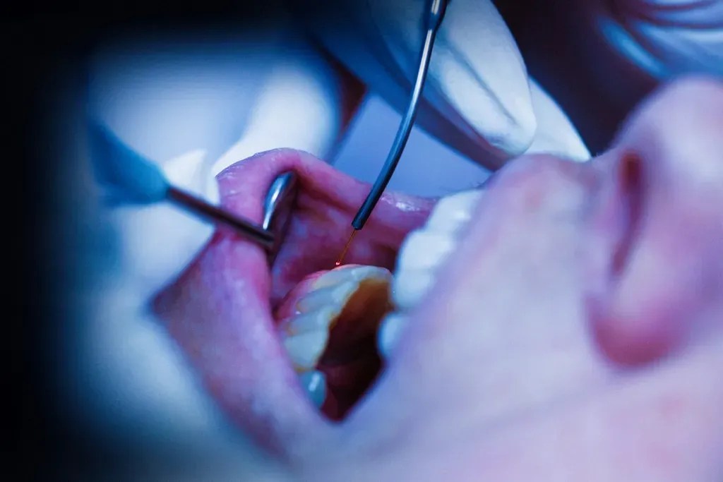 How Do Lasers Work in Dentistry? Capitol Premier Dental Group
