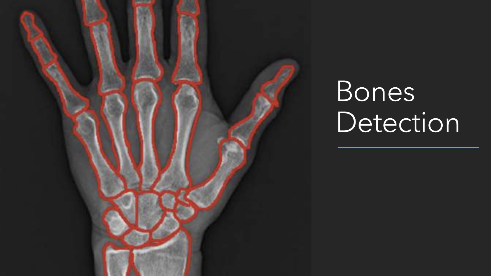 Projects XRay Bones Segmentation