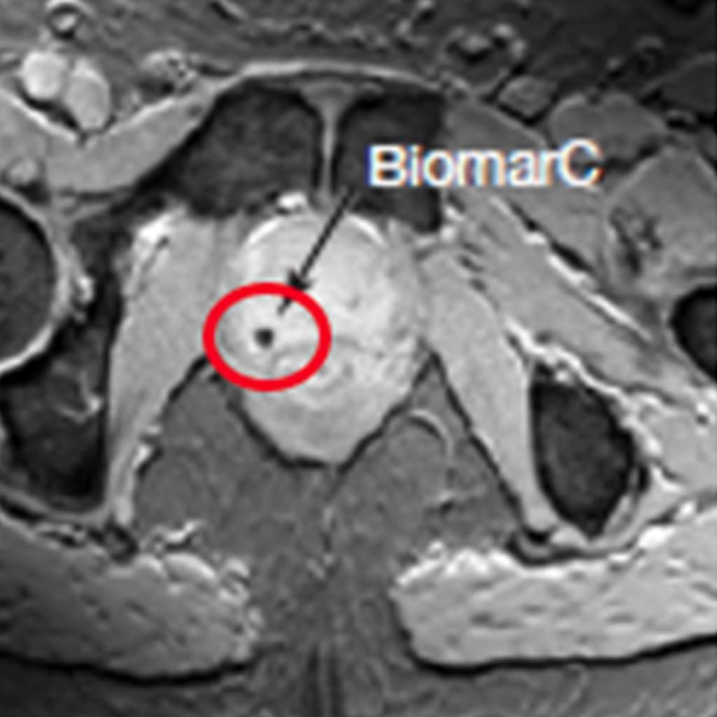 Fiducial Markers Carbon Medical Technologies