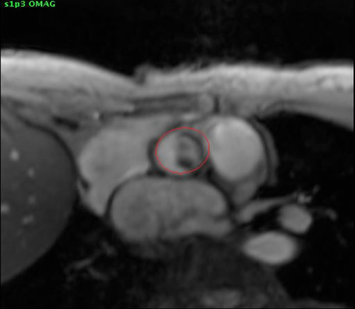 Mitral regurgitation Cardiac MRI