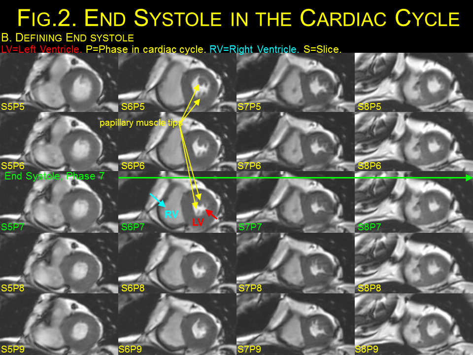 Stroke volume Cardiac MRI