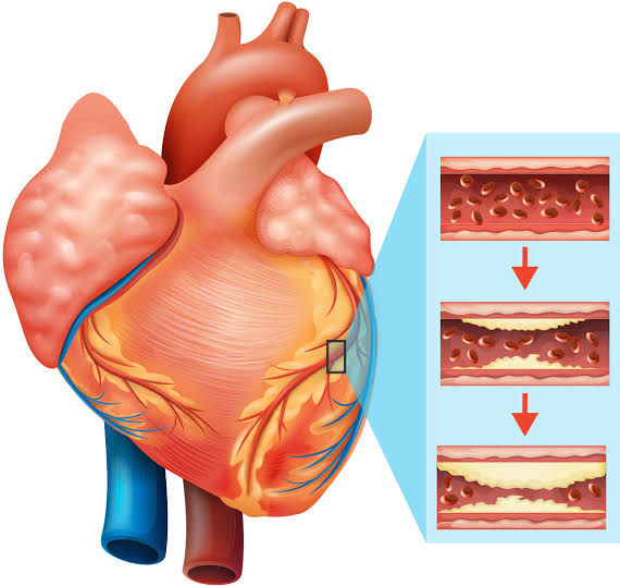 All you need to know about heart blockage by rapidlychanging lifestyle