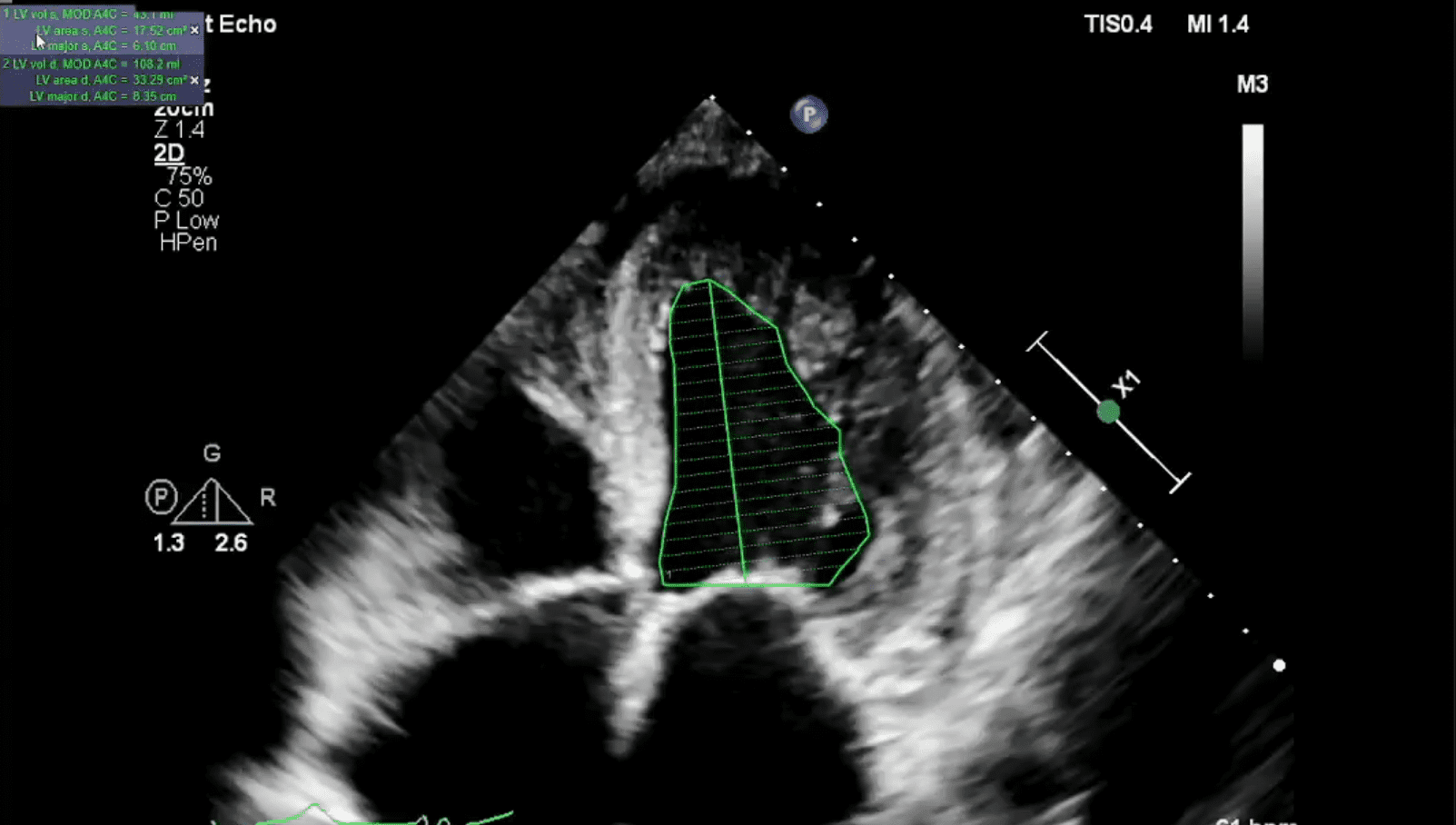 Echo AI Improves LVEF Workflow and Variability Cardiac Wire