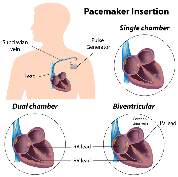 Biventricular Pacemaker Implantation Cape Town Cardiac