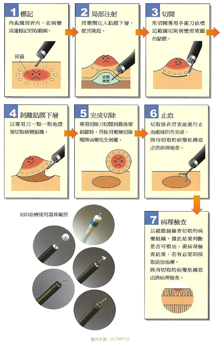 ESD/EMR 大腸鏡檢查/大腸息肉切除/大腸瘜肉/輝雄診所