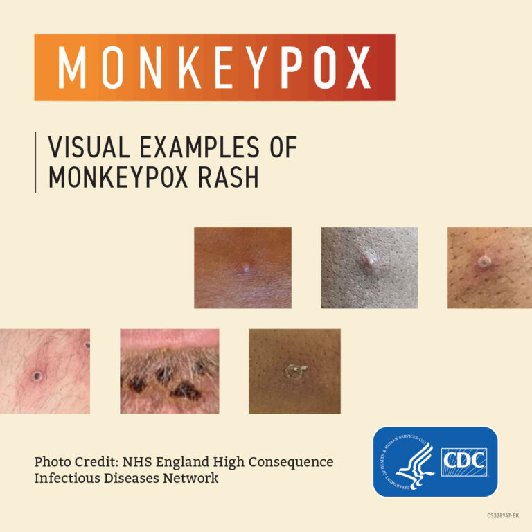 Monkeypox A Guide for Direct Care Workers CareAcademy
