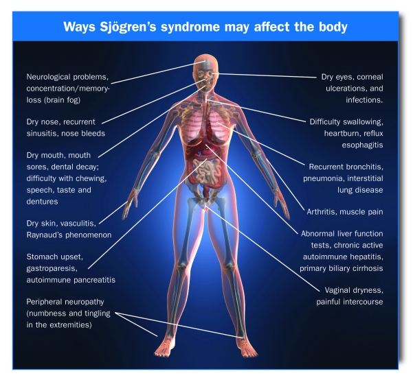 to Dr. Shenoy's CARE Hospital Sjogren`s Syndrome