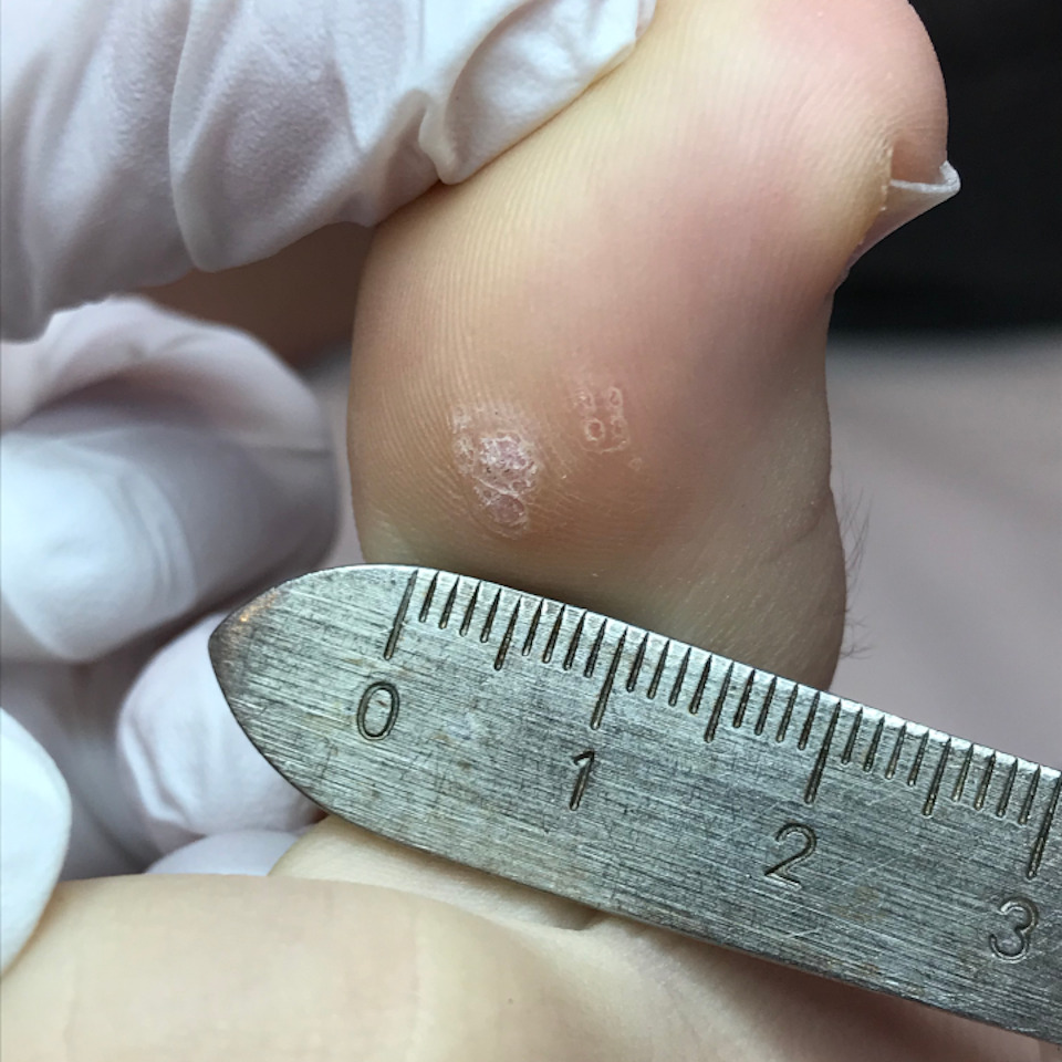 Verruca Treatment Options Care For Feet